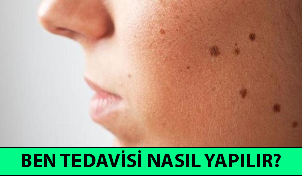 ben tedavisi nasıl yapılır