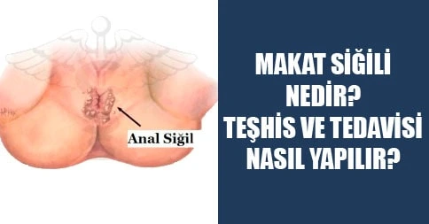 makat siğili kondilom tedavisi