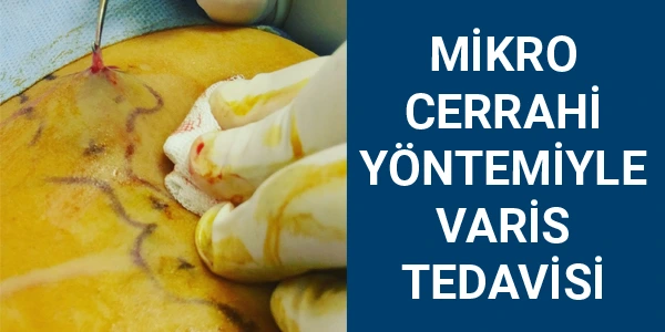 mikro cerrahi varis tedavisi