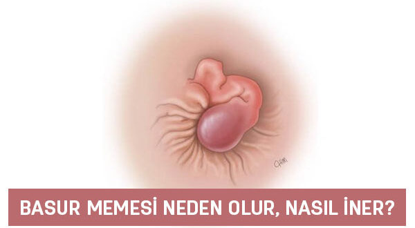 basur memesi neden olur nasil iner basur memesi patlatilir mi