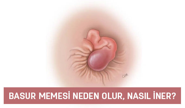 basur memesi neden olur