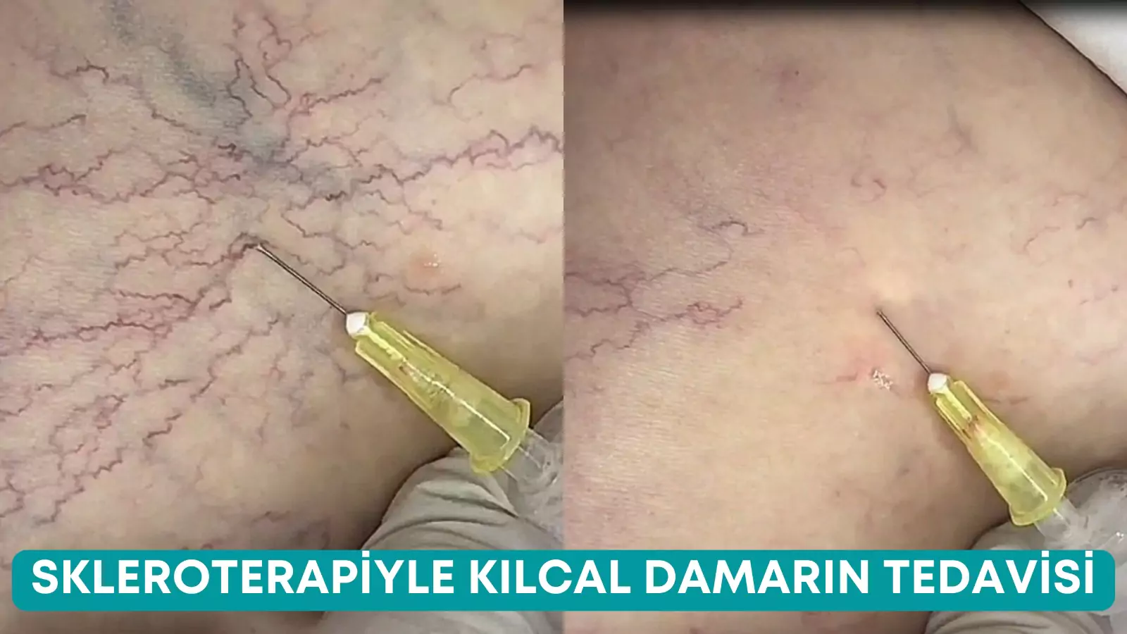 skleroterapi yöntemiyle kılcal varis tedavisi